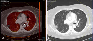 Patient with COVID-19 who had several pulmonary lesions with high attenuation. Dual-energy CT. CT angiography (dual-energy) showing no evidence of pulmonary thromboembolism (PTE). A) PBV imaging exhibiting no perfusion defects characteristic of PTE and showing homogeneous perfusion of the lung parenchyma. B) Lung window showing one of the lung lesions with the reversed halo sign.