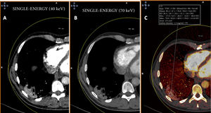 A patient with COVID-19. Dual-energy CT. A and B) Single-energy imaging showing right posterior and basal consolidation uptake, more obvious on low-energy single-energy imaging (40 KeV). C) Image from iodine map showing lesion uptake with an increase in density of 47 HU.