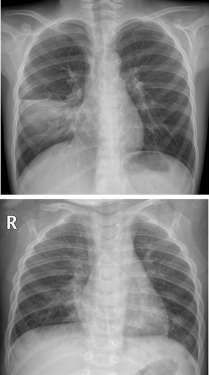 (A) Unilateral consolidation. 7-year-old boy with fever and cough of one week's course, with asymmetrical pulmonary auscultation. The posteroanterior X-ray showed parenchymal consolidation in the right middle lung field limited by the minor fissure, consistent with pneumonic consolidation. A SARS-CoV-2 PCR was not performed and COVID-19 was not suspected. No microbial agent was detected. (B) Bilateral consolidations. Girl aged 1 year and 2 months with fever and cough, with a family environment with similar cold symptoms. The anteroposterior X-ray shows bilateral peribronchial thickening, with areas of parenchymal consolidation in the middle lobe and left lower lobe. No SARS-CoV-2 PCR or other microbiological determinations were performed.