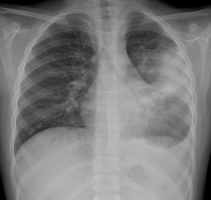 Consolidation with associated parapneumonic effusion in an 8-year-old girl with high fever and respiratory distress. The posteroanterior X-ray shows parenchymal consolidation in the upper-middle field of the left hemithorax with partial effacement of the heart border. There is also obliteration of the left lateral costophrenic angle associated with pleural effusion. She was hospitalised for 5 days with intravenous antibiotic therapy with a favourable course. No microbial agent was detected in the samples obtained and the SARS-CoV-2 PCR was negative.