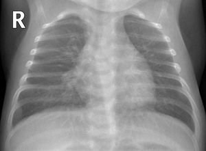 Pulmonary hyperinflation and peribronchial thickening. 1-Month-old boy with respiratory distress, cough and bilateral crackles. The anteroposterior X-ray shows signs of pulmonary hyperinflation and bilateral perihilar and paracardiac peribronchial thickening, with no parenchymal consolidations. No SARS-CoV-2 PCR or other microbiological determinations were performed.