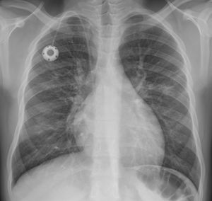 Increased interstitial markings. A 15-year-old adolescent with sickle cell anaemia and dilated myocarditis, with cough of 10 days’ course and hypoxaemia; a chest X-ray was performed with suspicion of COVID-19. The posteroanterior X-ray shows small faint opacities in the left and right middle lung fields, as well as increased interstitial markings. The cardiac silhouette is on the upper limit of normality with prominent hila and reservoir catheter with end in superior vena cava. The SARS-CoV-2 PCR was negative, and no other germs were detected in the microbiological study.