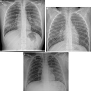 (A) Bilateral ground-glass opacities. 10-year-old girl with respiratory distress and signs and symptoms of fever of 4 days’ course associated with dry cough and rhinorrhoea. Positive familial epidemic context for COVID-19. The posteroanterior X-ray shows a slight increase in ground-glass density in the lower third of both hemithoraxes. No type of microbiological determination was performed, although it was clinically labelled as probable COVID-19. (B) Subpleural ground-glass opacity. 7-year-old boy with fever and cough of 5 days’ course, with a familial epidemic context positive for COVID-19. The anteroposterior X-ray shows a slight increase in subpleural ground-glass density in the middle-lower third of the right hemithorax (arrow), probably defined medially by the major fissure. No SARS-CoV-2 PCR or other microbiological determinations were performed; however, it was labelled as probable COVID-19. (C) Ground-glass opacities caused by Mycoplasma pneumoniae. 11-year-old boy with cough and fever of 8 days’ course (max. 39.5°C) with odynophagia. The portable supine decubitus X-ray shows increased ground-glass density with an increase in bronchovascular marking in the middle-lower field of the left hemithorax. In the assay, he had leucocytosis (14.9×1000/μL) and increased acute phase reactants (CRP 2.9mg/dL and procalcitonin 14ng/dL). Negative SARS-CoV-2 detection. He required hospitalisation for 3 days with good clinical course.