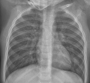 Human metapneumovirus infection. Boy aged 2 years and 4 months with fever and asymmetry in his auscultation; severe bronchospasm. The anteroposterior X-ray shows signs of bilateral and symmetrical pulmonary hyperinflation, peribronchial thickening and bilateral interstitial pattern. There is a small paracardiac opacity in the base of the left lung that may be a small atelectasis/mucus plug. No SARS-CoV-2 PCR was performed. He required admission to ICU with leucocytosis of 18.7×1000/μL and CRP 6.09mg/dL. He had a favourable course and was discharged after 3 days.