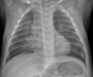 COVID-19 with parenchymal consolidation. 6-month-old boy with fever and cough. The anteroposterior X-ray shows peribronchial thickening and faint opacity that blurs the right contour of the cardiac silhouette in association with parenchymal consolidation in the middle lobe. The SARS-CoV-2 PCR was positive.