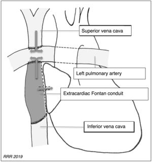 Modified extracardiac Fontan procedure. The inferior vena cava is connected by a prosthetic extracardiac conduit, which is anastomosed to the pulmonary artery, and the prior Glenn shunt is retained.