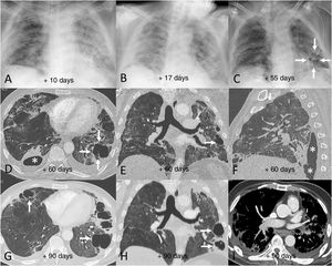 Example of poor radiological outcome in a 62-year-old male patient who required hospital admission due to SARS-CoV-2 infection and invasive mechanical ventilation for 12 days. After 90 days in hospital, the patient was discharged requiring long-term home oxygen therapy and needing rehabilitation. A–C) Chest X-rays corresponding to days 10 (A), 17 (B) and 55 (C) after the onset of symptoms showing extensive persistent bilateral opacities, which are beginning to resolve by the end of the hospital stay. Note the appearance of areas of lower density in the lung bases in relation to pneumatoceles (C, arrows). D–F) Chest computed tomography (CT) images 60 days after the onset of symptoms, in which extensive bilateral fibrotic lesions in the form of subpleural bands and bronchial dilation can be seen, in addition to peripheral air cysts compatible with pneumatoceles (arrows) in the right middle lobe and both lower lobes. One of the lesions in the right lower lobe is in contact with the pleural space, causing a hydropneumothorax (D and F, asterisks). G–I) Chest CT images 90 days after the onset of symptoms, showing a slight improvement in the fibrotic lesions but slightly more growth of the pneumatoceles in the right middle lobe and left lower lobe (arrows). Note the incidental detection of an eccentric filling defect in the left lower lobe artery (I, asterisk) consistent with a subacute pulmonary embolism.