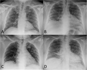 A) 52-year-old male post-COVID-19 whose follow-up chest X-ray shows subpleural reticular opacities, more evident in the right lung. B) 51-year-old male post-COVID-19 whose chest X-ray shows significant volume loss in both lungs and residual involvement in the form of linear subpleural opacities in the right lung. C) 56-year-old female post-COVID-19 whose follow-up chest X-ray shows a loss of volume in both lungs, peripheral laminar atelectasis in the right lung and some subpleural ground-glass opacities in the left upper lobe. D) 58-year-old female post-COVID-19 whose follow-up chest X-ray shows bilateral basal "band" opacities in relation to laminar atelectasis.