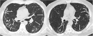 The most common findings on chest computed tomography (lung parenchyma window) in post-COVID-19 patients with radiological sequelae are subpleural parenchymal bands ("band opacities" and "subpleural lines", long arrows) with distortion of the lung architecture and secondary bronchial dilation (short arrows).