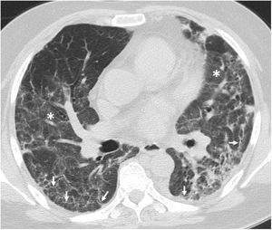 Chest computed tomography (lung parenchyma window) in a post-COVID-19 patient showing bilateral ground-glass opacification (asterisks) associated with coarse subpleural reticulation (arrows).