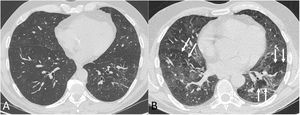 Chest computed tomography (lung parenchyma window) in inspiration (A) and expiration (B) in a post-COVID-19 patient with dyspnoea. In the expiratory phase of the study (B) a mosaic pattern is revealed (arrows). This pattern, which means the presence of areas of trapped air, is barely perceptible in the inspiratory phase.