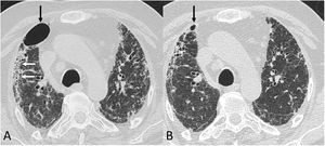 Chest computed tomography (lung parenchyma window) in a post-COVID-19 patient. A) A study from early June 2020 shows a pneumatocele (black arrow), bilateral coarse subpleural reticulation and areas of honeycombing (white arrows). B) In a follow-up study 8 weeks later, the pneumatocele (arrow) has significantly decreased in size.