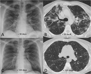 Example of good radiological recovery in terms of chest X-ray and computed tomography findings (lung parenchyma window) in a 45-year-old man with severe SARS-CoV-2 pneumonia after hospital discharge. A and B) Radiological tests 30 days after the onset of symptoms show patchy consolidation along with areas of ground-glass opacification and loss of volume. C and D) Radiological tests 120 days after onset of symptoms show radiological improvement with resolution of the consolidation and a reduction in the extension of the ground-glass opacification, with persistence of slight peripheral reticular interstitial involvement.