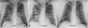 Example of good radiological recovery on chest X-ray in a 39-year-old male patient. A) Five days after the onset of symptoms, bilateral opacities can be seen, predominantly perihilar. B) 11 days after the onset of symptoms, radiological worsening is identified (greater density and extension of the opacities). C) Once discharged from hospital, follow-up chest X-ray 40 days after onset of symptoms shows complete radiographic resolution of the lung opacities.