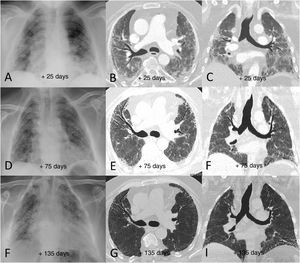 Example of poor radiological outcome in a 65-year-old male patient who required hospital admission due to SARS-CoV-2 infection and invasive mechanical ventilation for more than 15 days. The patient was finally discharged after 90 days in hospital, requiring home respiratory support and having significant limitations performing basic daily activities. A–C) Radiological tests performed 25 days after the onset of symptoms (7 days after extubation) show peripheral patchy parenchymal opacities predominantly in both middle and lower lung fields. D–F) The tests 75 days after the onset of symptoms showed slight radiological improvement of the opacities, with an architectural distortion detected in the computed tomography consisting of incipient areas of subpleural reticulation and bronchial dilation, mainly in the anterior segments of both upper lobes and in the left lower lobe. G–I) In the radiological follow-up 135 days after the onset of symptoms, the findings have barely changed with respect to the previous study (persistence of areas of subpleural reticulation and bronchial dilation).