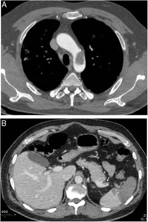 Thrombotic complications in patients with COVID-19 pneumonia: A) Free-floating thrombus in the aortic arch. B) Splenic infarction and small thrombus visible in the splenic vein (arrow). (Courtesy of Dr Gorospe [Hospital Ramón y Cajal, Madrid]).
