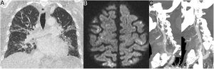 A 71-year-old man with a history of chronic kidney disease, liver failure, hypertension and acute COVID-19 infection. Chest computed tomography (CT) (A) showed patchy ground-glass opacities in both lungs that could be attributed to COVID-19. The patient presented right hemiparesis and dysarthria during admission. Brain magnetic resonance imaging (B, diffusion-weighted sequence) identified multiple small multiregional infarctions, and CT angiography (C and D) identified calcified atheromatous plaques in both carotid bifurcations.