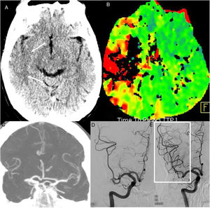 Acute arterial ischaemic lesions. A 63-year-old man attended at the hospital after having a stroke in the region of the right medial cerebral artery four hours earlier. PCR was positive for COVID-19. A single computed tomography (CT) scan (A) showed a right temporal cortical hypodensity (arrows) and perfusion CT (time-to-peak map) (B) showed a circulatory delay in the region of the right medial cerebral artery. CT angiography showed an occlusion of the right medial cerebral artery (C). Arteriography showed an occlusion of two divisions of the M2 segment of the medial cerebral artery (D) which were recanalised by means of mechanical thrombectomy (box in E).