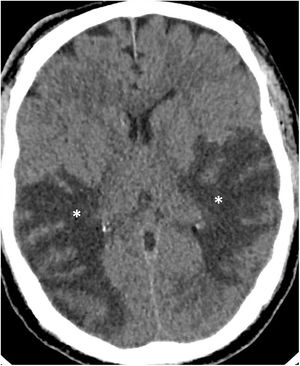 A 60-year-old man admitted to ICU due to COVID-19 pneumonia requiring intubation. During admission he presented left hemiparesis. A single computed tomography scan showed hypodense lesions in the periventricular and subcortical white matter (asterisks) in both temporal and parietal lobes. Acute diffuse leukoencephalopathy in a critically ill patient was suspected. (Figure courtesy of Dr Cristina Utrilla [Hospital La Paz, Madrid]).