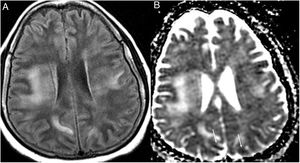 A 35-year-old woman with nosocomial SARS-CoV-2 infection, with headache and low-grade fever. Magnetic resonance imaging showed confluent lesions in the periventricular and subcortical supratentorial white matter hyperintense on the T2-FLAIR sequence (A) and with diffusion restriction in the apparent diffusion coefficient (ADC) (arrows) (B). Posterior reversible encephalopathy syndrome was suspected. (Figure courtesy of Dr Cristina Utrilla [Hospital La Paz, Madrid]).