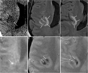A 48-year-old woman with acute COVID-19 who had developed sensory abnormalities in the left half of her body four to five days earlier. An initial computed tomography scan showed a right insular hypodense lesion (arrows in A). Subsequent magnetic resonance imaging determined the lesion to be juxtacortical and hyperintense on the T2-FLAIR sequence (arrows in B and C), with some bright foci on the diffusion-weighted sequence (arrow in D) and haemorrhagic foci on T2-weighted imaging* (arrows in E and F). These findings raised suspicion of acute haemorrhagic necrotising encephalitis.