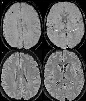 A 35-year-old man admitted for acute COVID-19 and serious lung impairment which required treatment with an extracorporeal membrane oxygenation system. He presented altered consciousness. Brain magnetic resonance imaging showed multiple hypointense foci that were juxtacortical and in the corpus callosum on MRI susceptibility-weighted imaging (arrows in A); these could be attributed to microhaemorrhages or microthrombosis and were not associated with parenchymal lesions on T2-FLAIR imaging (B).