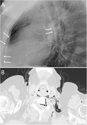 A 63-year-old woman with dyspnoea. A) The chest X-ray (lateral projection) showed pneumomediastinum with air delimiting the anterior wall of the intrathoracic trachea and the cardiac silhouette (white arrows). B) The computed tomography also revealed the presence of air in the medullary canal (black arrows). Subsequent radiological studies showed resolution of the extrapulmonary thoracic air (not shown).