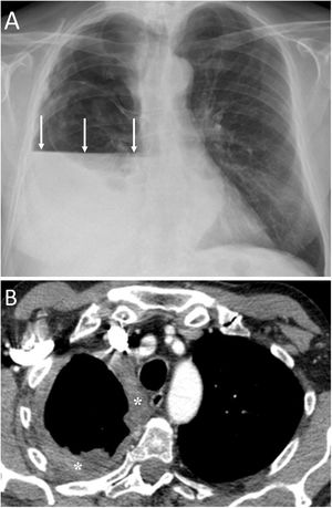 A 69-year-old man with progressive dyspnoea and chest pain. A) The chest X-ray showed an air-fluid level that occupied the entire right hemithorax, indicative of a hydropneumothorax (white arrows). B) Computed tomography after pleural drainage showed the presence of nodular pleural thickening with involvement of the mediastinal pleura (white asterisks). Videothoracoscopy revealed the presence of multiple right pleural nodules, a biopsy of which was positive for pleural mesothelioma.