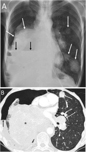 A 57-year-old man with a disseminated lung neoplasm undergoing chemotherapy. A) The chest X-ray revealed a right lung mass with left lung nodules (white arrows) and an air-fluid level in the right hemithorax due to hydropneumothorax (black arrows). B) The computed tomography scan revealed a large right lung mass (black asterisk), lung nodules and masses and contralateral hilar adenopathies (white arrows), and the right hydropneumothorax (black arrow). The patient died within a few days.