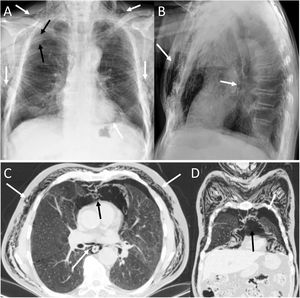 A 72-year-old man with a pulmonary nodule in the right upper lobe. Percutaneous fine needle (22 G) lung puncture cytology was of a non-small cell lung neoplasm. A and B) The chest X-ray 72 h after the procedure revealed signs of pneumomediastinum and significant subcutaneous emphysema (white arrows). The biopsied pulmonary nodule can be seen in the periphery of the right upper lobe in the posteroanterior view of the chest X-ray (black arrows). B and C) Computed tomography confirmed pneumomediastinum and subcutaneous emphysema and showed predominantly left bilateral pneumothorax (white arrows) with communication between both pleural spaces in the anterior junctional line (black arrows), probably of congenital origin, since there was no previous thoracic surgery. The subcutaneous emphysema was drained through an incision in the chest wall and multiple pleural adhesions were identified during the surgical procedure of right upper lobectomy.