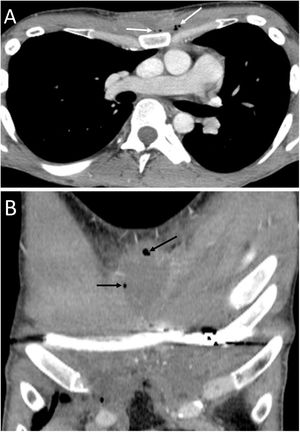 A 29-year-old man with previous surgery to correct pectus excavatum, who presented with oedema in the left chest wall and spontaneous discharge of purulent material from the surgical wound. A) Computed tomography with intravenous contrast showed a presternal hypodense collection in the subcutaneous cellular tissue with air bubbles (white arrows). B) The multiplanar reconstruction in the coronal plane clearly showed this collection with air bubbles (black arrows) corresponding to a chest wall abscess.