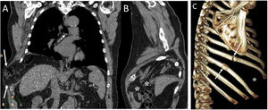 A 55-year-old man with a mass on the right chest wall of more than two years of evolution. A) Computed tomography (multiplanar reconstruction in coronal and sagittal planes) revealed a right transdiaphragmatic intercostal hernia with colon and abdominal fat (white arrows). C) Multiplanar reconstruction in the sagittal plane enabled identification of the diaphragmatic defect (white asterisks). B) The 3D (sagittal plane) showed fracture calluses in the lateral arches of the eighth and ninth right ribs (white arrows) with widening of the intercostal space (white asterisk).