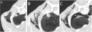 A 60-year-old man with a right apical pulmonary nodule biopsied by fine needle puncture (22 G). A) After the injection of the local anaesthetic, a subcutaneous emphysema (white asterisk) appeared, although the needle and the plunger were previously purged of air. B) The subcutaneous emphysema was partially drained to prevent its progression and facilitate puncture (black arrow). C) Finally, the procedure was successfully performed with the appearance of a pneumothorax (white asterisk). The patient remained asymptomatic at all times.