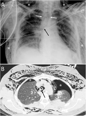 A 36-year-old woman with attempted autolysis due to ingestion of benzodiazepines and acute respiratory failure, who presented with subcutaneous cervicofacial and thoracic emphysema after intubation. A) The chest X-ray revealed massive subcutaneous emphysema (white asterisks), hyperdistention of the endotracheal tube balloon (white arrows) and the distal end of the endotracheal tube in the proximal segment of the right main bronchus (black arrow). B) Computed tomography revealed pneumomediastinum with significant subcutaneous emphysema (black asterisks), bilateral pneumothorax (white asterisks) and hyperdistention of the endotracheal tube balloon with deformity of the posterior wall of the intrathoracic trachea (black arrow) due to post-intubation tracheal rupture. Treatment consisted of inserting two pleural drainage tubes for bilateral pneumothorax and selective intubation of the right main bronchus, with extubation at 36 h.