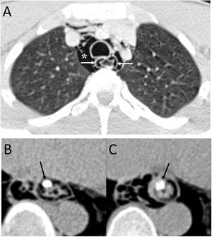A 20-year-old man with a history of endoscopy to assess food impaction. A) Computed tomography (CT) showed the presence of pneumomediastinum (white asterisk), with air inside the submucosal layer of the oesophageal wall (white arrows) and pneumoperitoneum with retropneumoperitoneum (not shown in the image). B) After the administration of oral contrast, no leakage was identified and it was located within the submucosa layer of the oesophageal wall (black arrows). The diagnosis was an intramucosal oesophageal dissection, and the patient