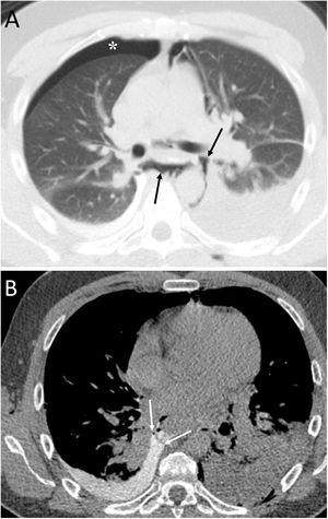A 36-year-old woman with abdominal pain after vomiting. A) Computed tomography enabled visualisation of pneumomediastinum (black arrows) and right pneumothorax (white asterisk). B) After the administration of oral contrast, perforation in the distal oesophagus was identified with the passage of oral contrast into the right pleural cavity, due to an oesophagopleural fistula (white arrows) associated with Boerhaave