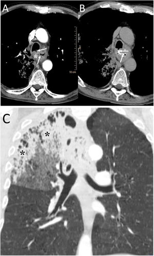 A 58-year-old man with fever and dysphagia. A and B) The computed tomography showed an oesophageal wall thickening (white asterisk) and a fistulous path between the oesophagus and the intrathoracic trachea, clearly visualised when oral contrast was administered (white arrows). C) In the pulmonary parenchyma window, pulmonary consolidation was visualised in the right upper lobe (black asterisks). The radiological findings indicated an oesophageal neoplasm with tracheo-oesophageal fistula and aspiration pneumonia in the right lung. The patient was treated by placing an oesophageal endoprosthesis, with significant clinical improvement.