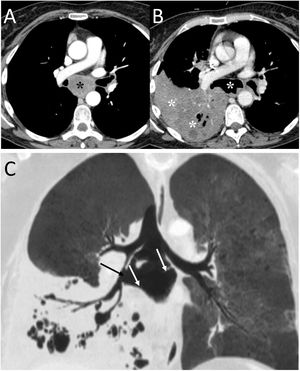 A 48-year-old man with lung neoplasia treated with surgery and chemotherapy. A and B) The computed tomography (CT) scan showed the presence of a subcarinal adenopathy (black asterisk) that in the next control CT scan necrotised and filled with air (white asterisk). In addition, a right lower lobe lung consolidation was seen due to aspiration pneumonia (white asterisks). C) MinIP reconstruction (coronal plane) revealed a fistula between the intermediate bronchus (black arrow) and the necrotic adenopathy (white arrows).