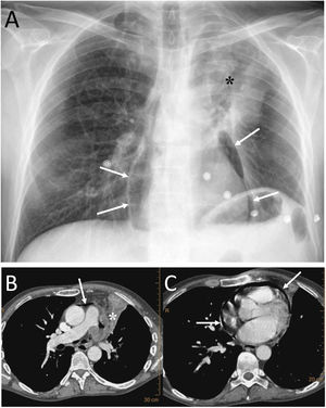 A 53-year-old man with squamous cell carcinoma of the lung presented with chest pain, fever and productive cough. A) The chest X-ray showed a lung mass in the left upper lobe (black asterisk) and pneumopericardium (white arrows). B and C) Computed tomography showed progression of the upper left lung mass (asterisk) and pneumopericardium secondary to the direct extension of the tumour to the pericardium (white arrows).