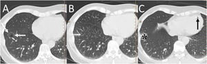 A 57-year-old woman with a pulmonary nodule awaiting surgery. A) Computed tomography (CT) showed a subsolid pulmonary nodule in the right lower lobe (white arrows). B and C) Preoperative marking was performed with CT-guided radiotracer injection, identifying pulmonary haemorrhage (black asterisk) and air bubbles in the right ventricle post-procedure (black arrow). When performing the subsequent scintigraphy, no focal deposit of the intrapulmonary radiotracer was identified and its distribution was observed in the liver and kidneys. The injection of the radiotracer was considered to be intravascular in a branch of the left inferior pulmonary vein. The procedure was repeated without incident and the intraoperative biopsy of the lesion showed adenocarcinoma in situ, for which a lower left lobectomy was performed.