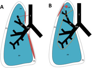 Types of bronchopleural fistula (in red). A) Central: between the pleural space and the trachea, main bronchi, lobar bronchi or segmental bronchi. B) Peripheral: between the pleural space and the airway distal to the segmental bronchi or pulmonary parenchyma. T: Trachea. MB: main bronchus. LB: lobar bronchus. SB: segmental bronchus. PP: pulmonary parenchyma. PS: pleural space. Orange line: boundary between central and peripheral bronchopleural fistulas.
