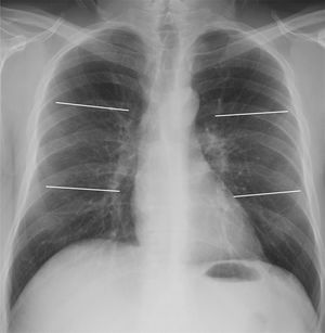 Posteroanterior chest X-ray demonstrating division into 6 lung fields (quantification systems 6A and 6B) by two horizontal lines: upper lung field (from vertices to lower margin of the aortic knob), middle (lower margin of aortic knob to the middle third of heart border) and lower (middle third of heart border to costophrenic sinuses).
