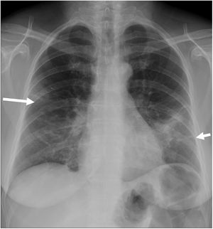 55-year-old woman with COVID-19 infection. The posteroanterior chest X-ray shows a peripheral focal opacity in the right midfield (arrow), a focal consolidation in the midfield/left base, and a linear opacity in the left base (short arrow). Quantification: 4/6 fields and 5/8 fields, corresponding to severe involvement in system 6A, moderate in system 6B and moderate in system 8.