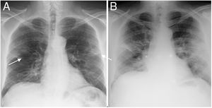 48-year-old man with COVID-19-associated pneumonia. A) Posteroanterior chest radiograph showing bilateral and linear alveolar opacities of peripheral distribution (arrows). The score is 3/6 fields and 4/8 fields, which correspond to moderate involvement in the three systems 6A, 6B and 8. B) The anteroposterior X-ray performed 72 h later shows a worsening of the radiological pattern with more extensive involvement and pulmonary consolidations. Quantification: 5/6 fields and 6/8 fields, corresponding to severe involvement in systems 6A and 6B, and moderate in system 8.