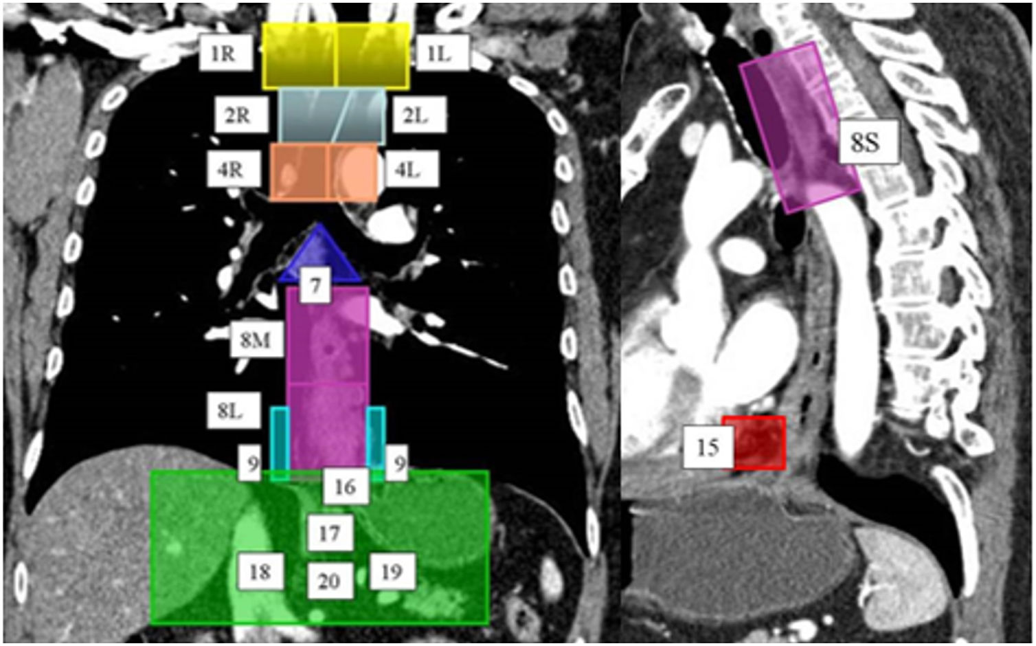 An Updated Review Of The TNM Classification System For Cancer Of The an-updated-review-of-the-tnm-classification-system-for-cancer-of-the