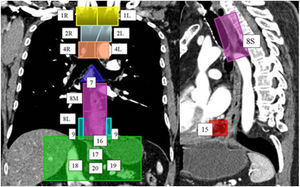 Lymphatic drainage system of the oesophagus. A computed tomography scan with coronal and sagittal reconstruction, using colours and numbers, shows the lymph node map proposed by the American Joint Committee on Cancer for the staging of oesophageal cancer. Right (1 R) and left (1L) lower cervical paratracheal lymph node chains; right (2 R) and left (2L) upper paratracheal lymph node chains; right (4 R) and left (4L) lower paratracheal lymph node chains; sub-carinal lymph node chains (7); upper thoracic paraoesophageal lymph node chains (8 S), middle thoracic lymph node chains (8M) and lower thoracic lymph node chains (8L); right (9 R) and left (9L) pulmonary ligament chains; diaphragmatic lymph node chains (15); paracardiac lymph node chains (16); left gastric lymph node chains (17); common hepatic lymph node chains (18); splenic lymph node chains (19); and coeliac lymph node chains (20).