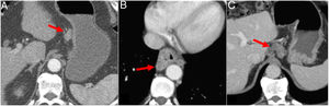 Radiological findings by multidetector computed tomography suggesting possible malignancy of lymph nodes: irregular contour (arrow in A), hyperuptake (arrow in B) and necrosis (arrow in C). gr6.