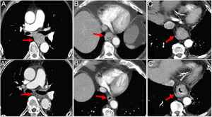 Assessment of response with multidetector computed tomography after neoadjuvant therapy in 3 different cases of oesophageal cancer (OC). A) Middle thoracic OC (arrow) with complete radiological response after neoadjuvant therapy (arrow in A