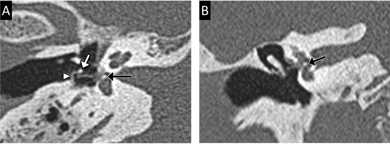Mloop Prothesis Radiological evaluation of the postsurgical middle ear | Radiología ...