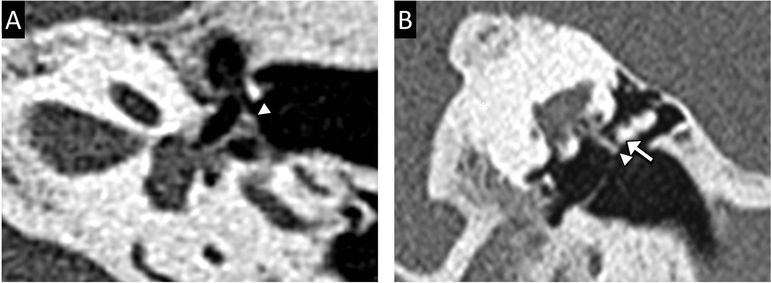 Radiological evaluation of the postsurgical middle ear | Radiología ...